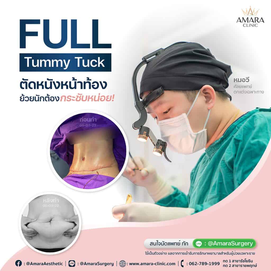 Full Tummy Tuck
